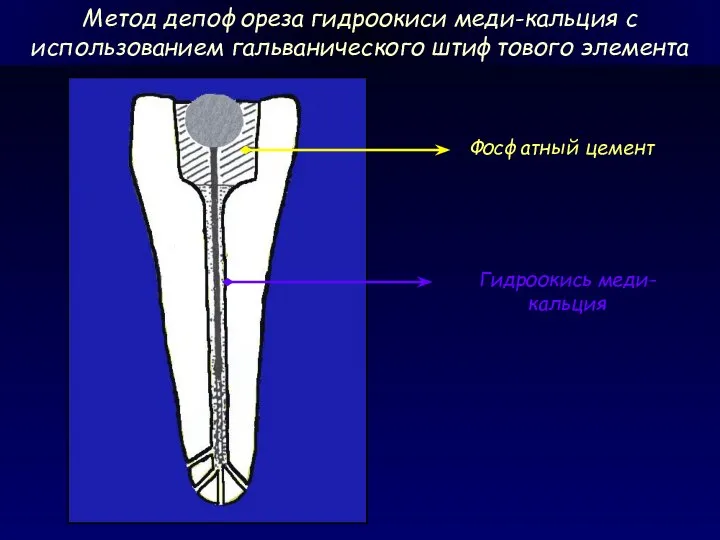 Метод депофореза гидроокиси меди-кальция с использованием гальванического штифтового элемента Фосфатный цемент Гидроокись меди-кальция