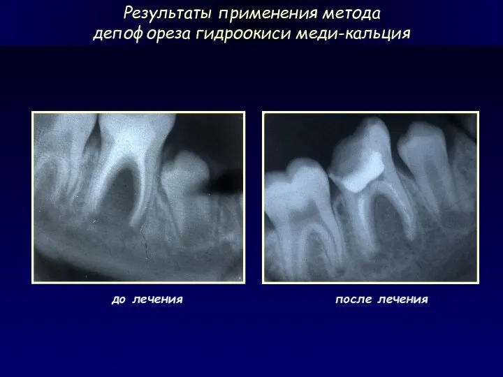 Результаты применения метода депофореза гидроокиси меди-кальция до лечения после лечения