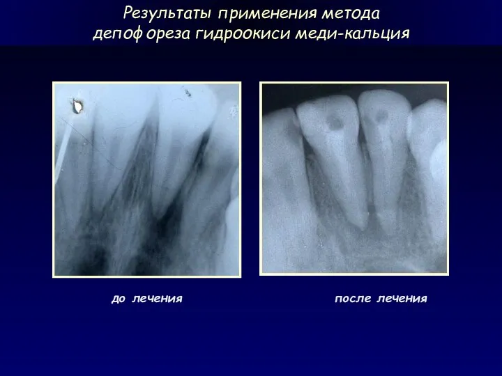 до лечения после лечения Результаты применения метода депофореза гидроокиси меди-кальция