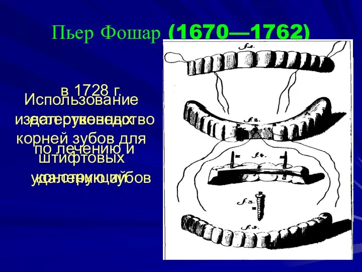 Пьер Фошар (1670—1762) в 1728 г. издал руководство по лечению и