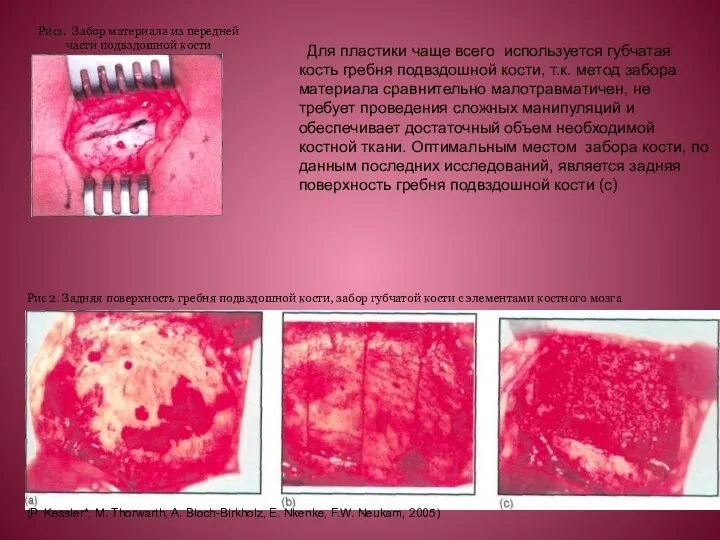 Для пластики чаще всего используется губчатая кость гребня подвздошной кости, т.к.