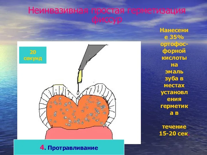 Неинвазивная простая герметизация фиссур 20 секунд 4. Протравливание Нанесение 35% ортофос-