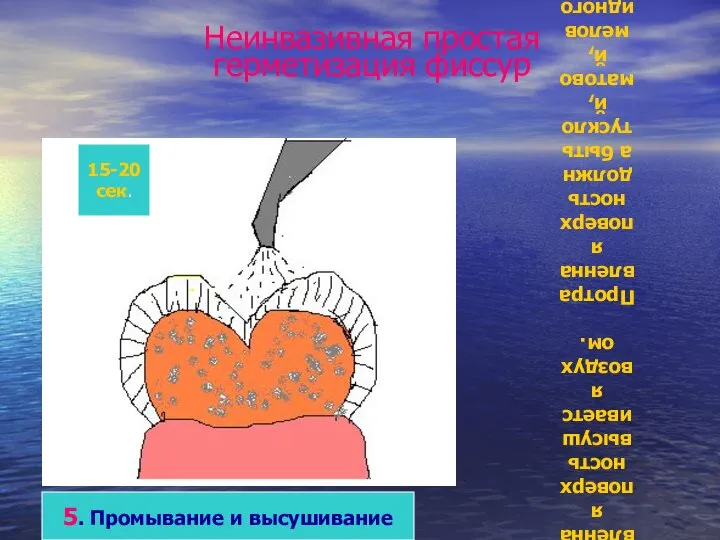 Неинвазивная простая герметизация фиссур 5. Промывание и высушивание Кислота в течение