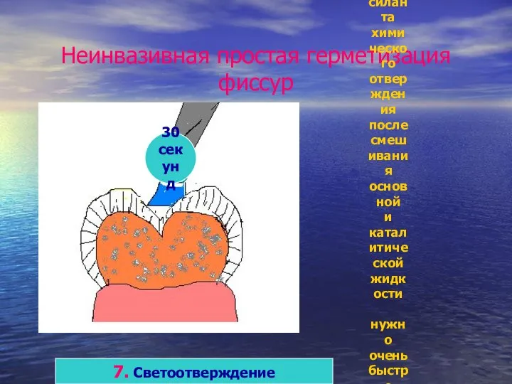 Неинвазивная простая герметизация фиссур 7. Светоотверждение 30 секунд При использовании силанта