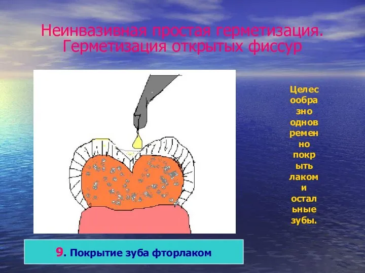 Неинвазивная простая герметизация. Герметизация открытых фиссур 9. Покрытие зуба фторлаком Целесообразно