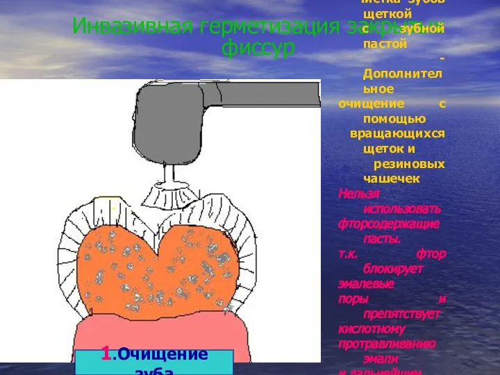 Инвазивная герметизация закрытых фиссур 1.Очищение зуба - Чистка зубов щеткой с