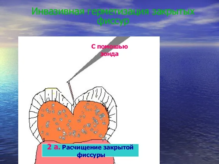 Инвазивная герметизация закрытых фиссур 2 а. Расчищение закрытой фиссуры С помошью зонда