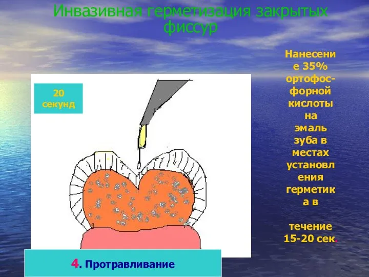 Инвазивная герметизация закрытых фиссур 20 секунд 4. Протравливание Нанесение 35% ортофос-