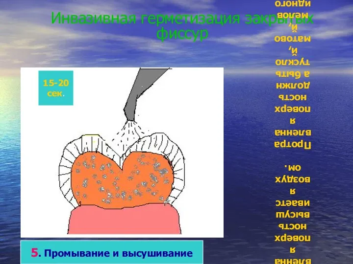 Инвазивная герметизация закрытых фиссур 5. Промывание и высушивание Кислота в течение