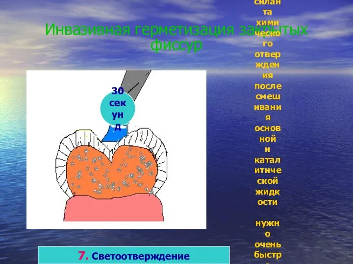 Инвазивная герметизация закрытых фиссур 7. Светоотверждение 30 секунд При использовании силанта