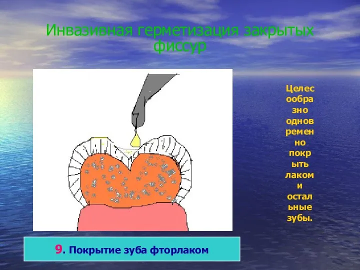 Инвазивная герметизация закрытых фиссур 9. Покрытие зуба фторлаком Целесообразно одновременно покрыть лаком и остальные зубы.