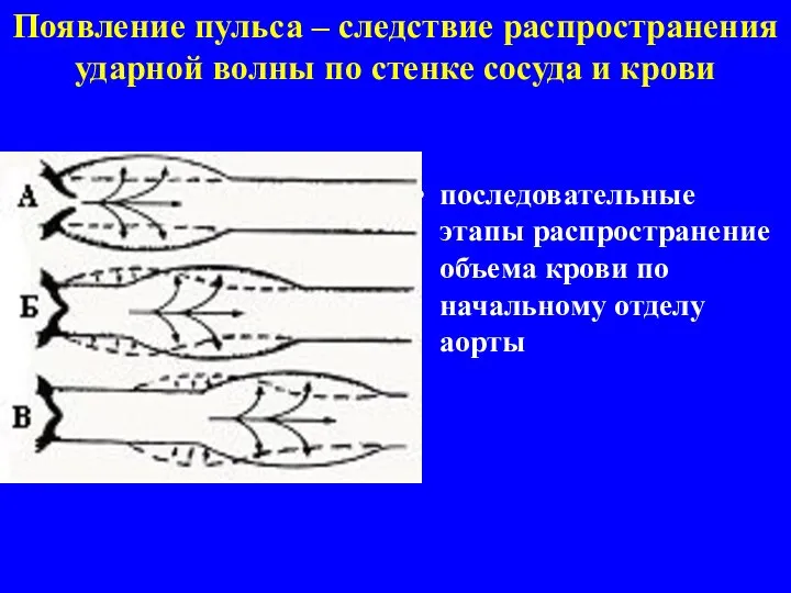 Появление пульса – следствие распространения ударной волны по стенке сосуда и