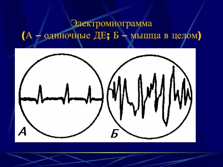 Электромиограмма (А – одиночные ДЕ; Б – мышца в целом)