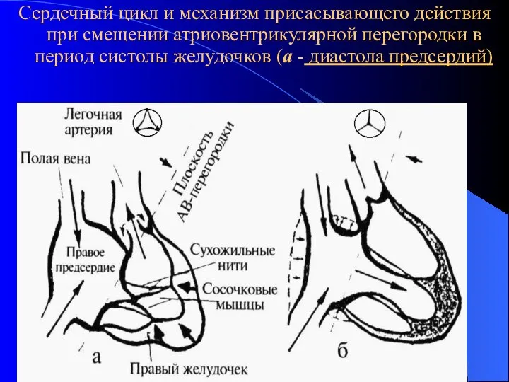 Сердечный цикл и механизм присасывающего действия при смещении атриовентрикулярной перегородки в