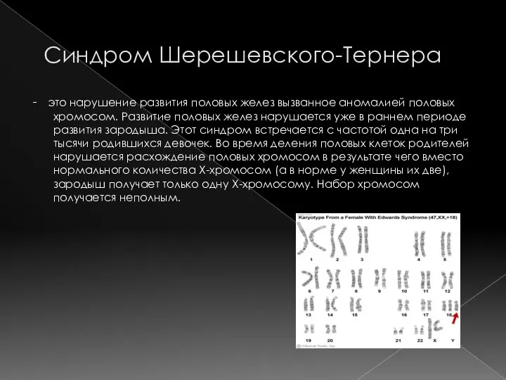 Синдром Шерешевского-Тернера - это нарушение развития половых желез вызванное аномалией половых