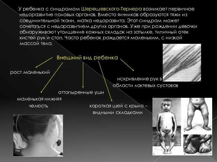 У ребенка с синдромом Шерешевского-Тернера возникает первичное недоразвитие половых органов. Вместо