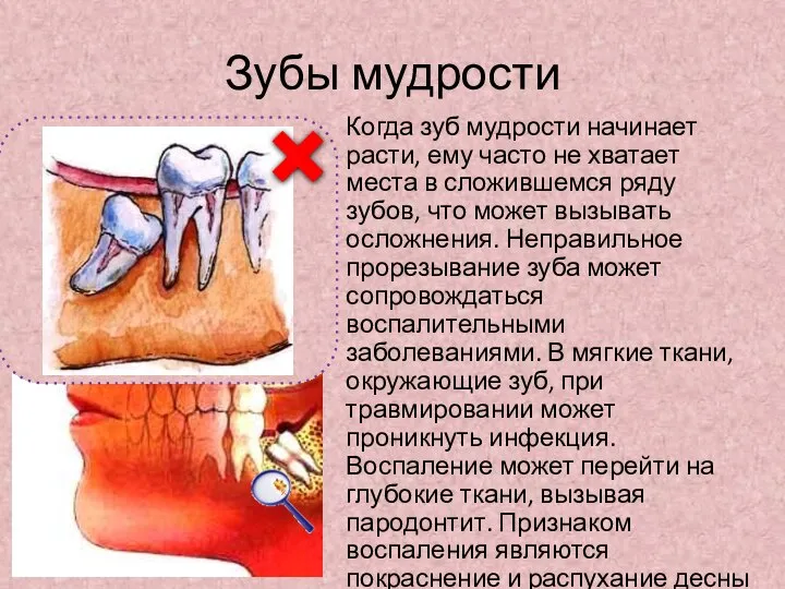 Зубы мудрости Когда зуб мудрости начинает расти, ему часто не хватает