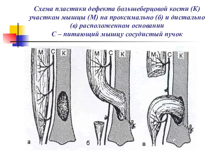 Схема пластики дефекта большеберцовой кости (К) участком мышцы (М) на проксимально
