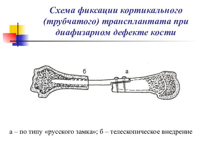 Схема фиксации кортикального (трубчатого) трансплантата при диафизарном дефекте кости а –