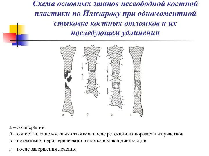 Схема основных этапов несвободной костной пластики по Илизарову при одномоментной стыковке