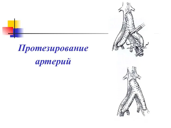 Протезирование артерий