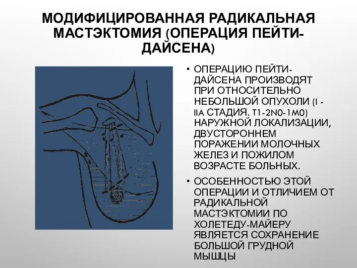 Модифицированная радикальная мастэктомия (операция Пейти-Дайсена) Операцию Пейти-Дайсена производят при относительно небольшой