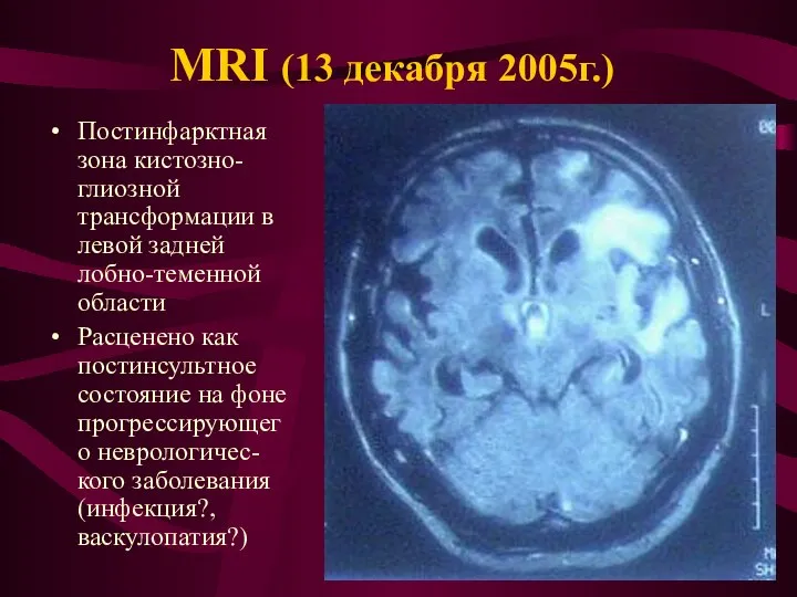 MRI (13 декабря 2005г.) Постинфарктная зона кистозно-глиозной трансформации в левой задней