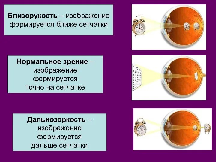 Близорукость – изображение формируется ближе сетчатки Нормальное зрение – изображение формируется