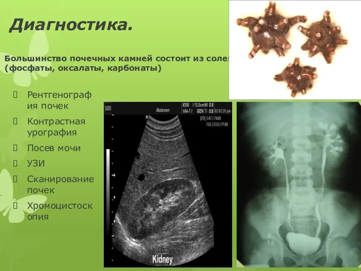 Диагностика. Большинство почечных камней состоит из солей кальция(фосфаты, оксалаты, карбонаты) Рентгенография