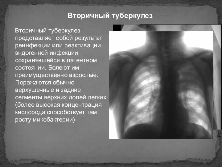 Вторичный туберкулез Вторичный туберкулез представляет собой результат реинфекции или реактивации эндогенной