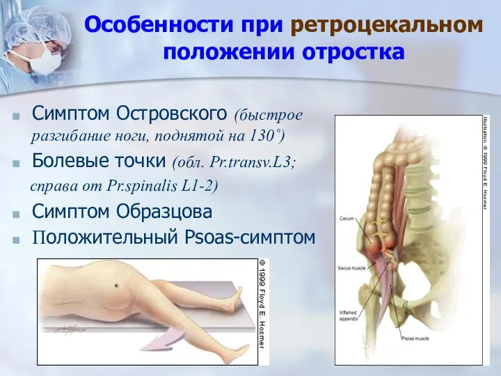 Особенности при ретроцекальном положении отростка Симптом Островского (быстрое разгибание ноги, поднятой