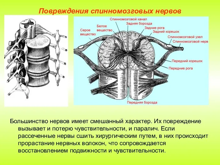 Повреждения спинномозговых нервов Большинство нервов имеет смешанный характер. Их повреждение вызывает