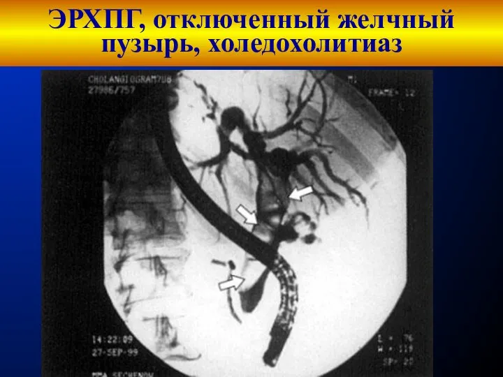 ЭРХПГ, отключенный желчный пузырь, холедохолитиаз