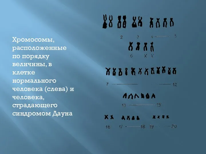 Хромосомы, расположенные по порядку величины, в клетке нормального человека (слева) и человека, страдающего синдромом Дауна