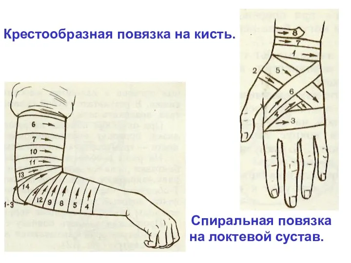 Крестообразная повязка на кисть. Спиральная повязка на локтевой сустав.