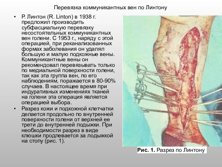 Р. Линтон (R. Linton) в 1938 г. предложил производить субфасциальную перевязку