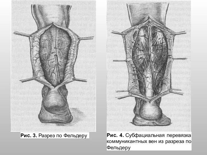 Рис. 3. Разрез по Фельдеру Рис. 4. Субфациальная перевязка коммуникантных вен из разреза по Фельдеру