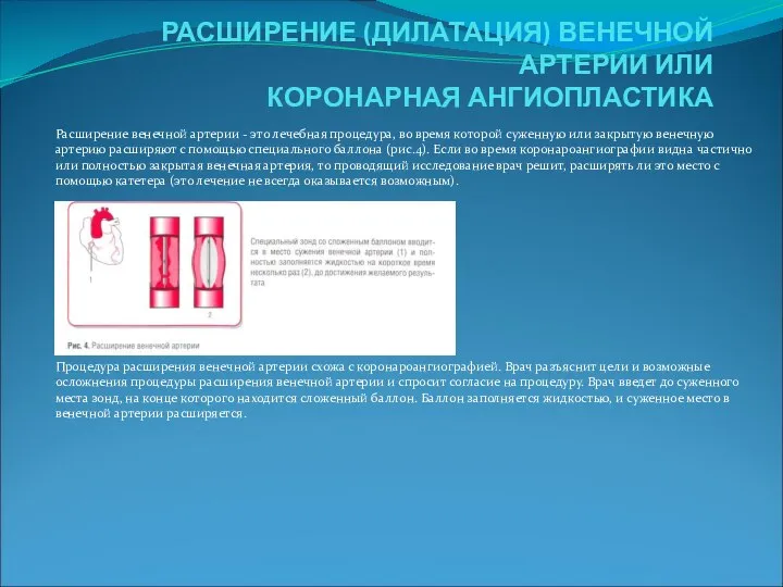 РАСШИРЕНИЕ (ДИЛАТАЦИЯ) ВЕНЕЧНОЙ АРТЕРИИ ИЛИ КОРОНАРНАЯ АНГИОПЛАСТИКА Расширение венечной артерии -