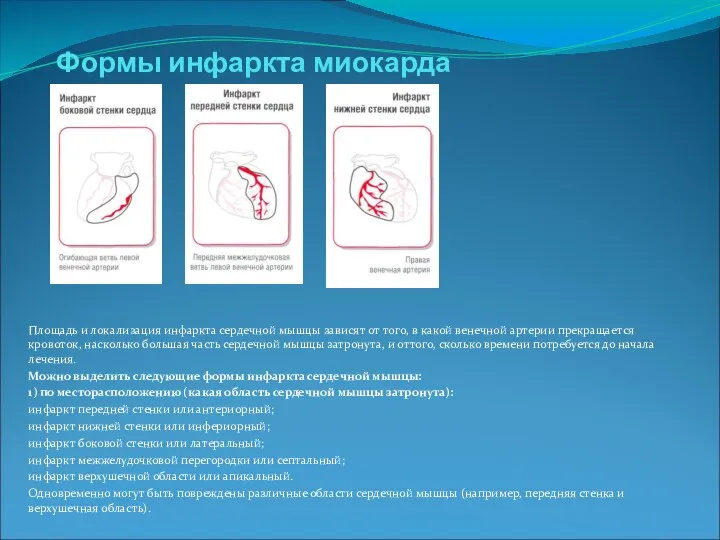 Формы инфаркта миокарда Площадь и локализация инфаркта сердечной мышцы зависят от