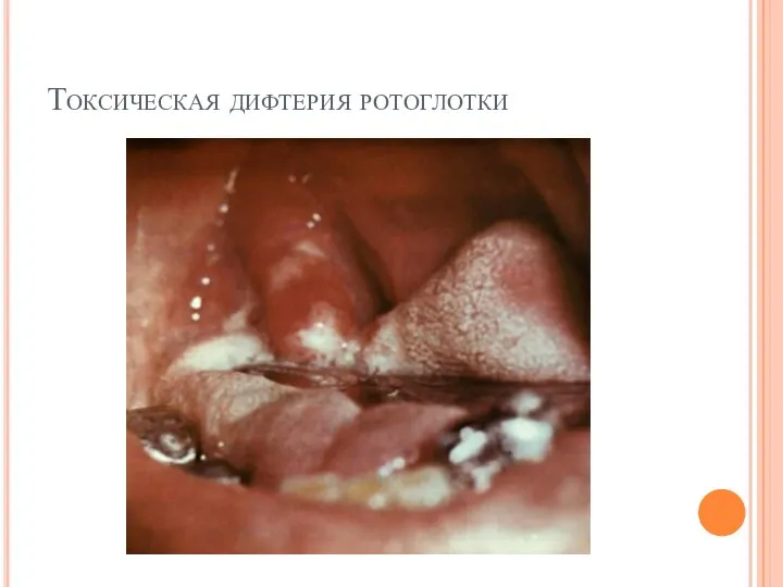Токсическая дифтерия ротоглотки