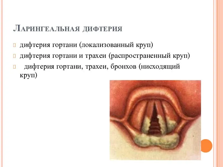 Ларингеальная дифтерия дифтерия гортани (локализованный круп) дифтерия гортани и трахеи (распространенный