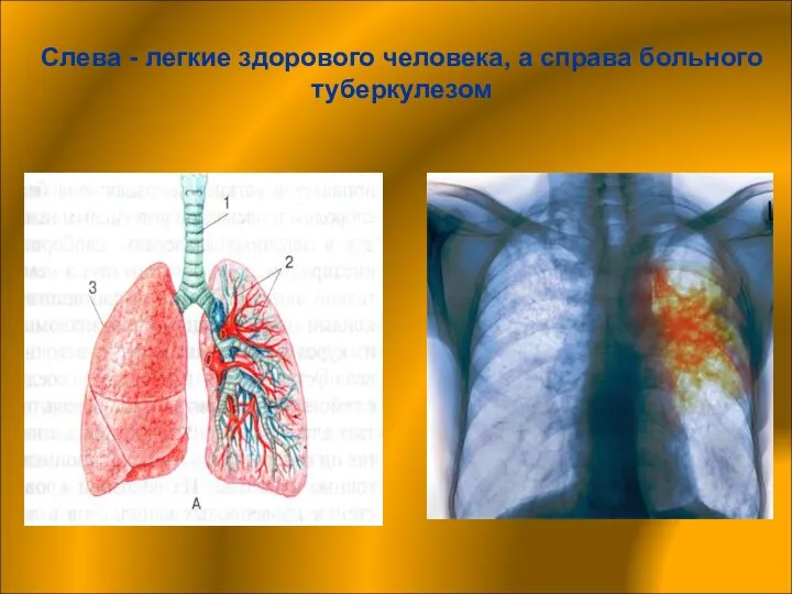 Слева - легкие здорового человека, а справа больного туберкулезом