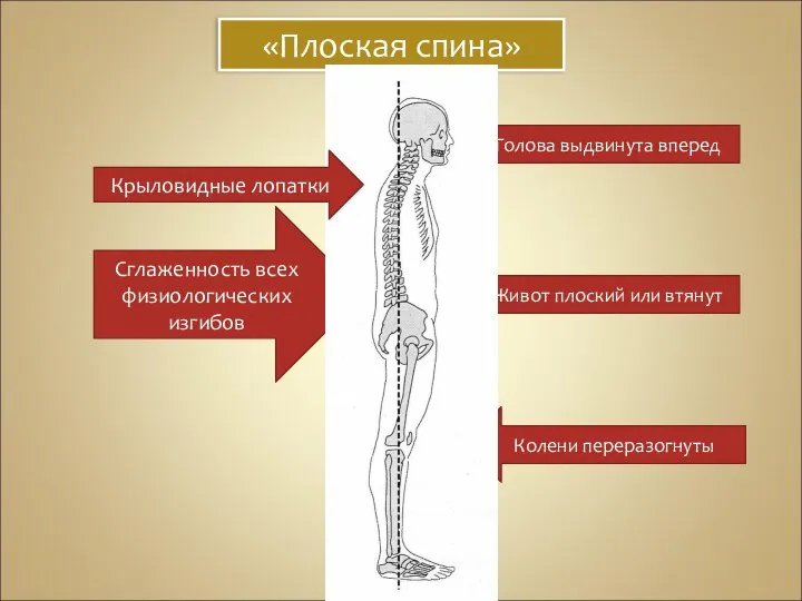 «Плоская спина» Голова выдвинута вперед Живот плоский или втянут Колени переразогнуты