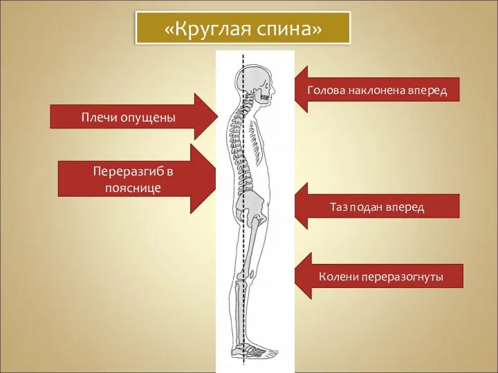 «Круглая спина» Голова наклонена вперед Таз подан вперед Колени переразогнуты Переразгиб в пояснице Плечи опущены