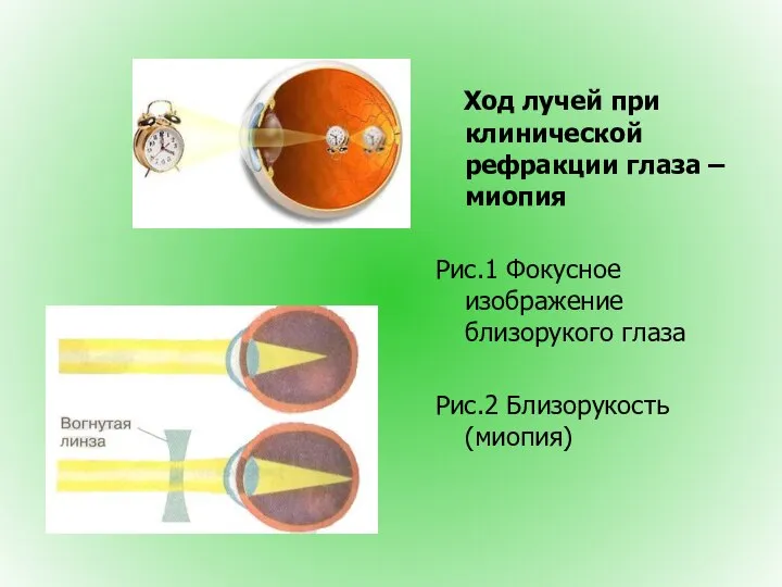 Ход лучей при клинической рефракции глаза – миопия Рис.1 Фокусное изображение близорукого глаза Рис.2 Близорукость (миопия)