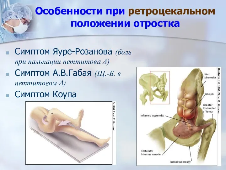 Особенности при ретроцекальном положении отростка Симптом Яуре-Розанова (боль при пальпации петтитова