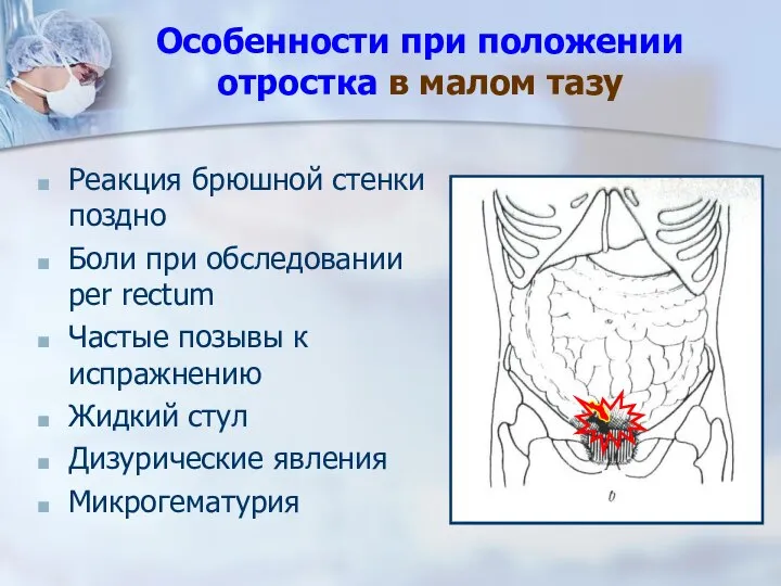 Особенности при положении отростка в малом тазу Реакция брюшной стенки поздно