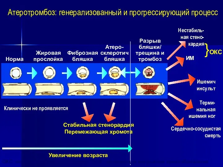 Норма Жировая прослойка Фиброзная бляшка Атеро- склеротич бляшка Разрыв бляшки/ трещина