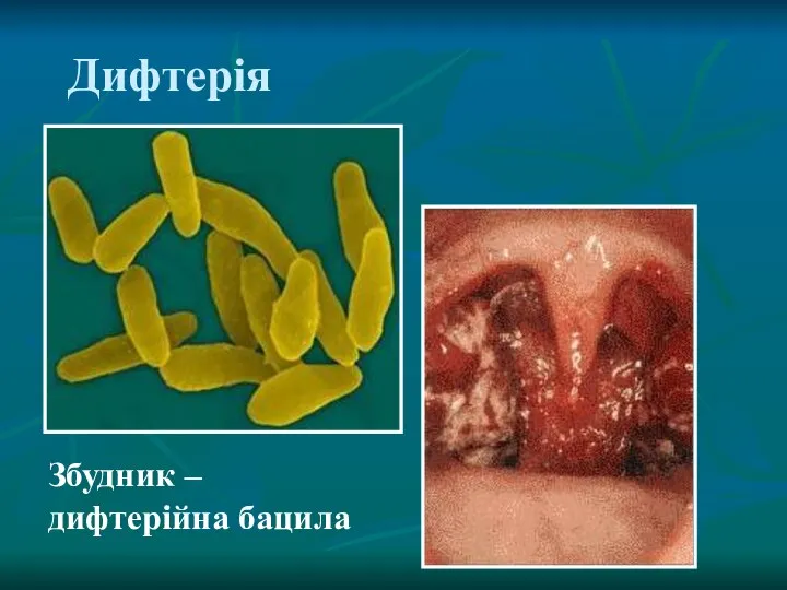 Дифтерія Збудник – дифтерійна бацила