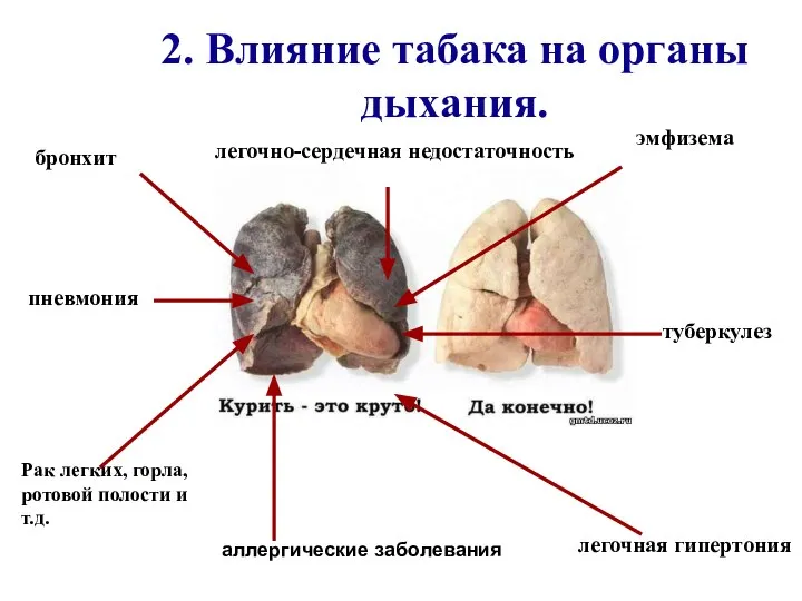 2. Влияние табака на органы дыхания. пневмония бронхит Рак легких, горла,